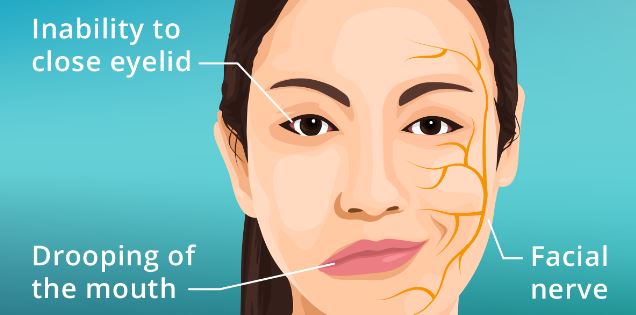 Homeopathy For Bells Palsy India